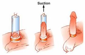 Andrology Treatment 1