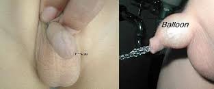 Undescended Testis